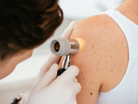 dermatologické vyšetrenie znamienok